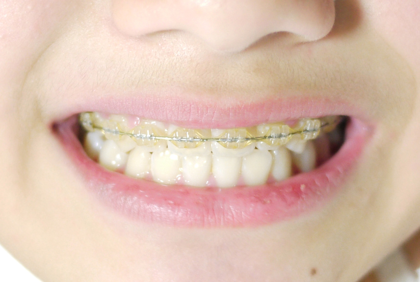 小児矯正は将来を見据えた「虫歯予防」